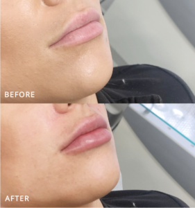 lip filler aftercare